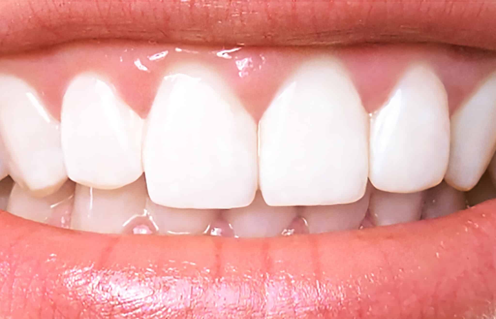 blanqueamiento dental scaled